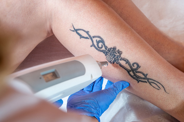 Laser Tattoo Removal | Cosmetic Derma Medicine